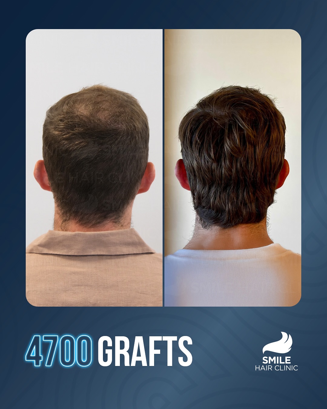 Before and After  graft    transplant at 