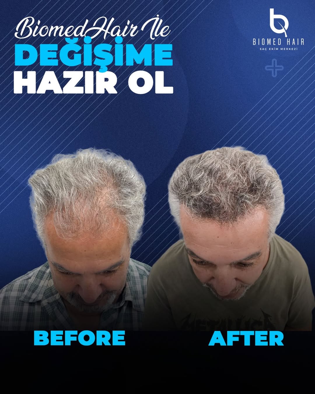DHI Hair Transplant Result