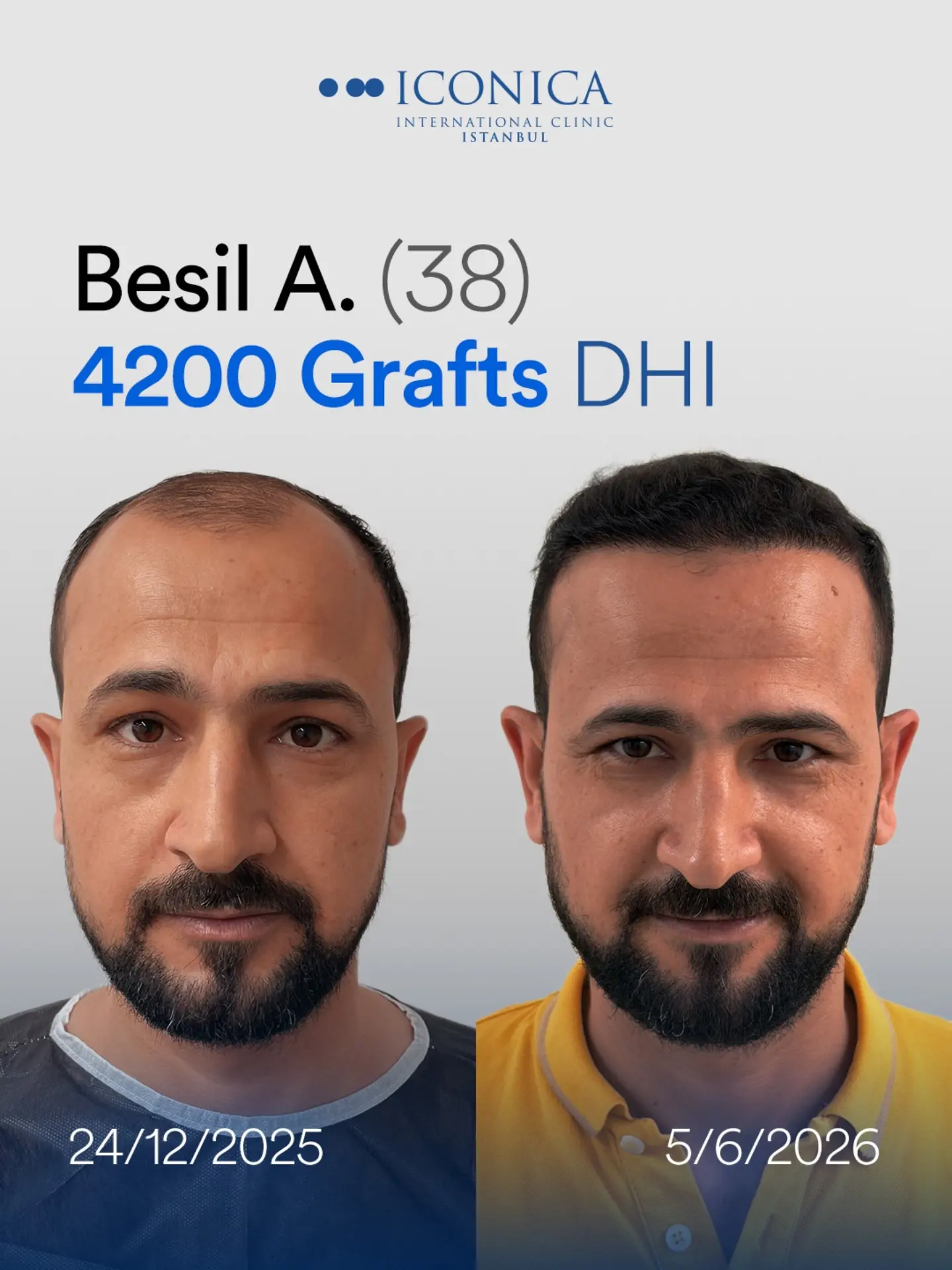 4200 grafts DHI hair transplant result before and after