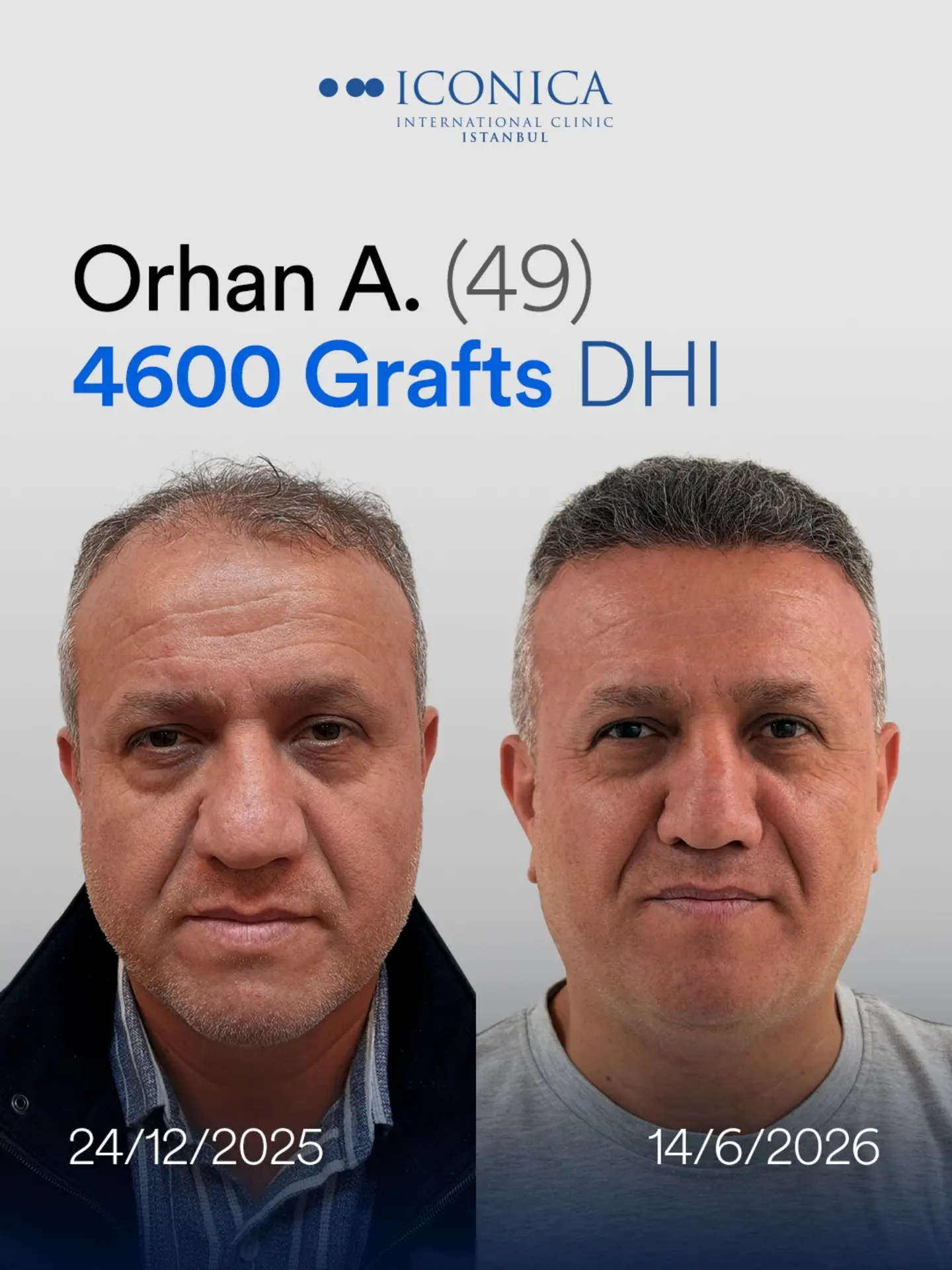 4600 grafts DHI hair transplant result before and after