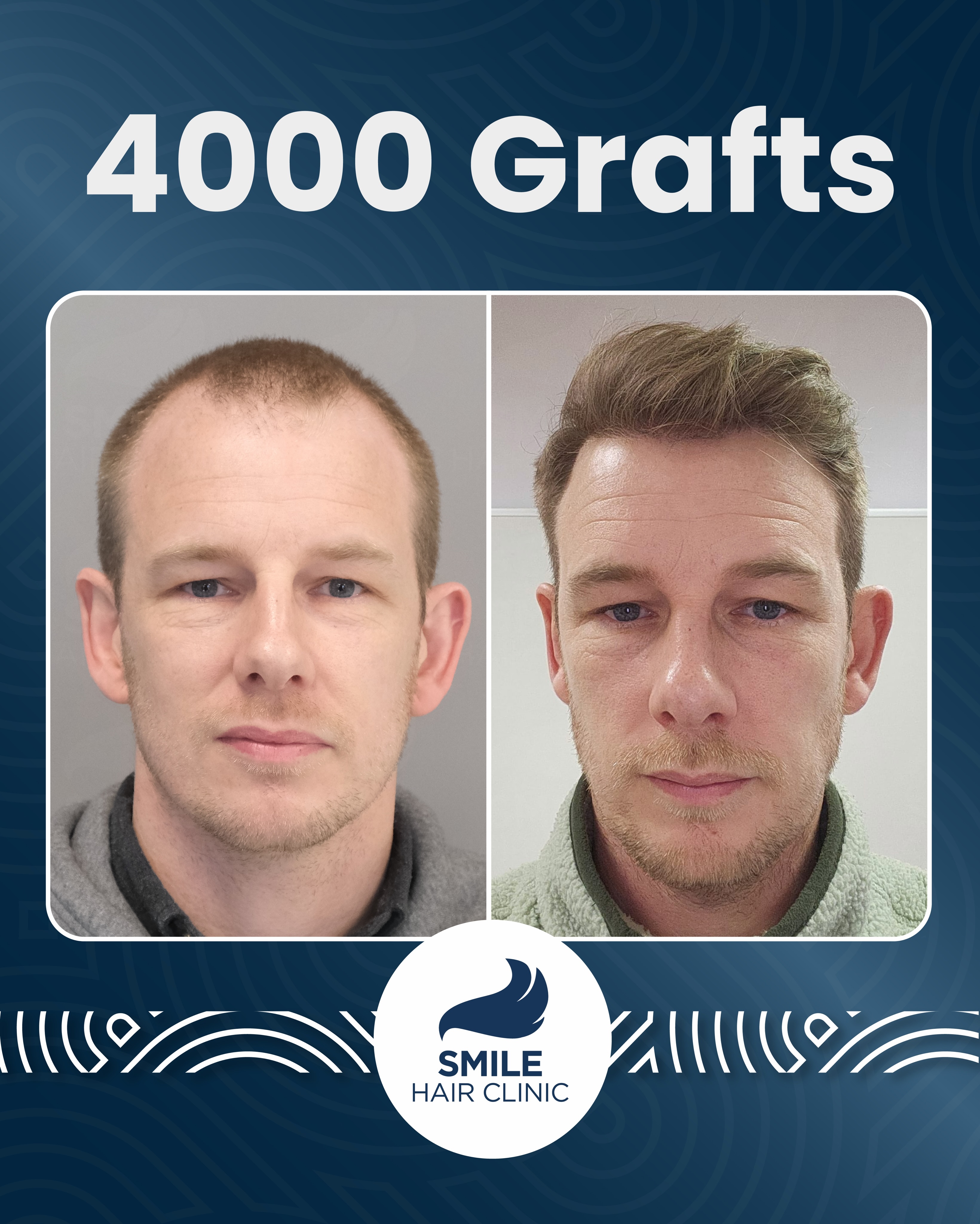 4000 grafts FUE hair transplant result before and after