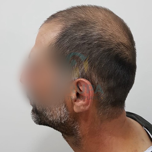 Before and After  graft    transplant at 