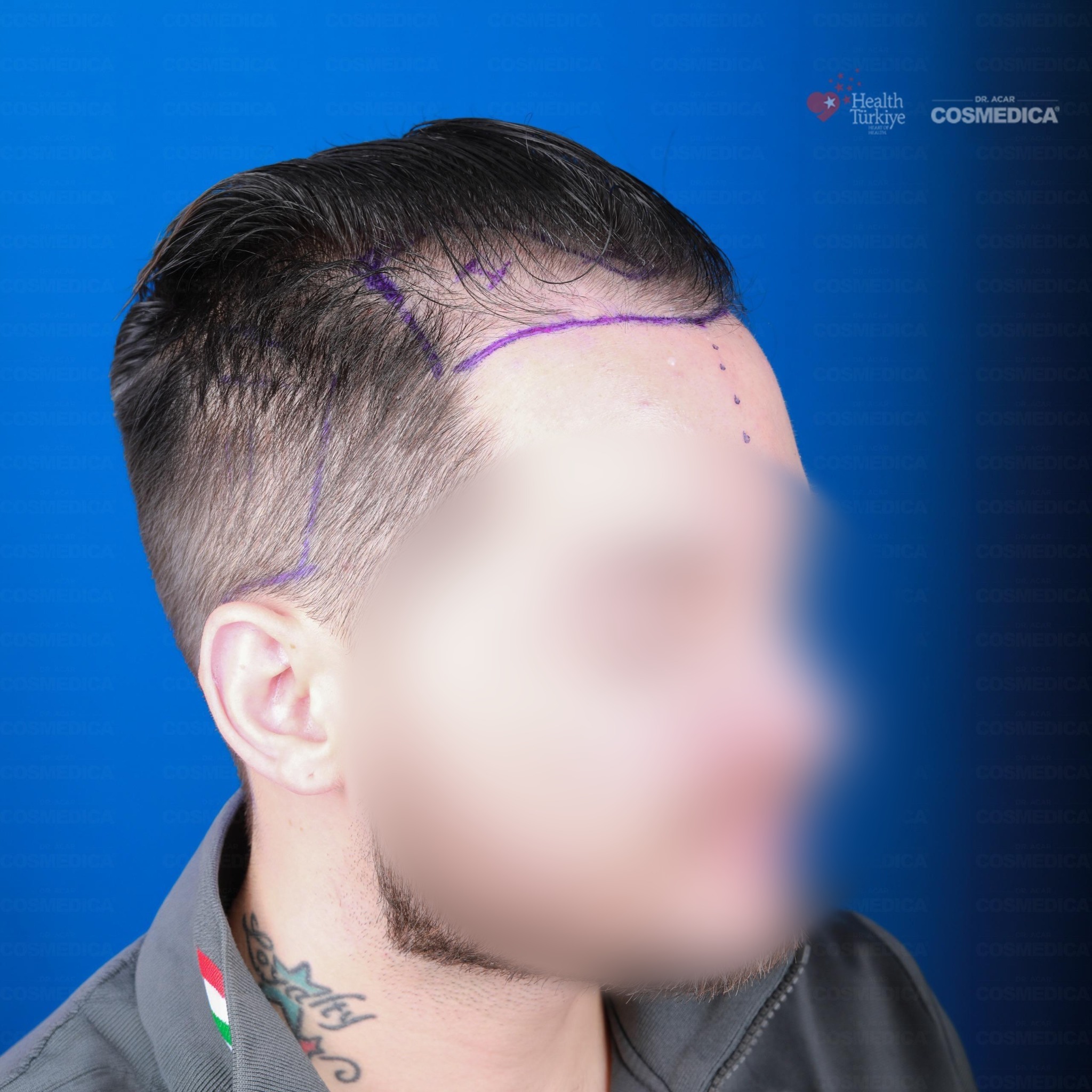 Before and After  graft    transplant at 