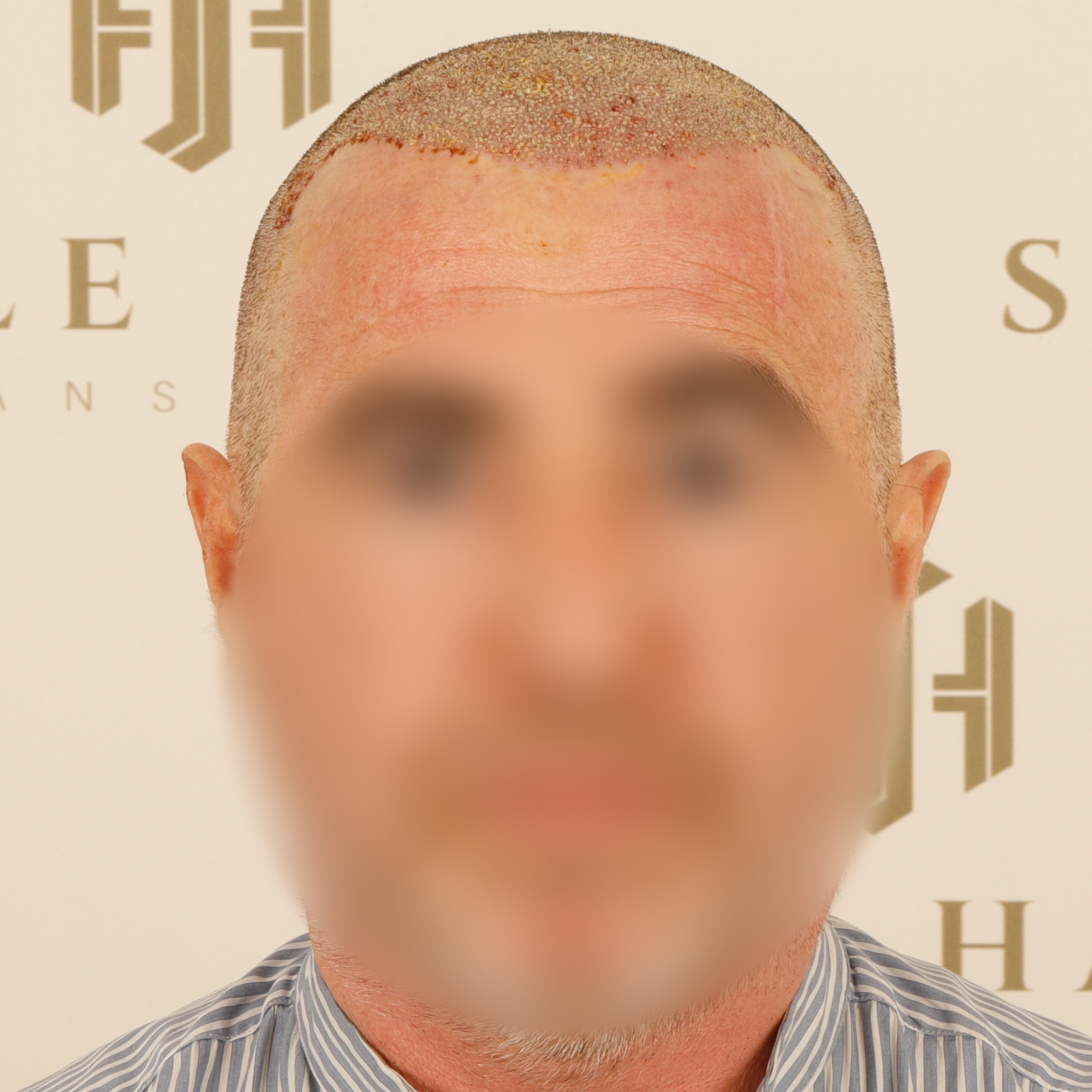 Before and After  graft    transplant at 