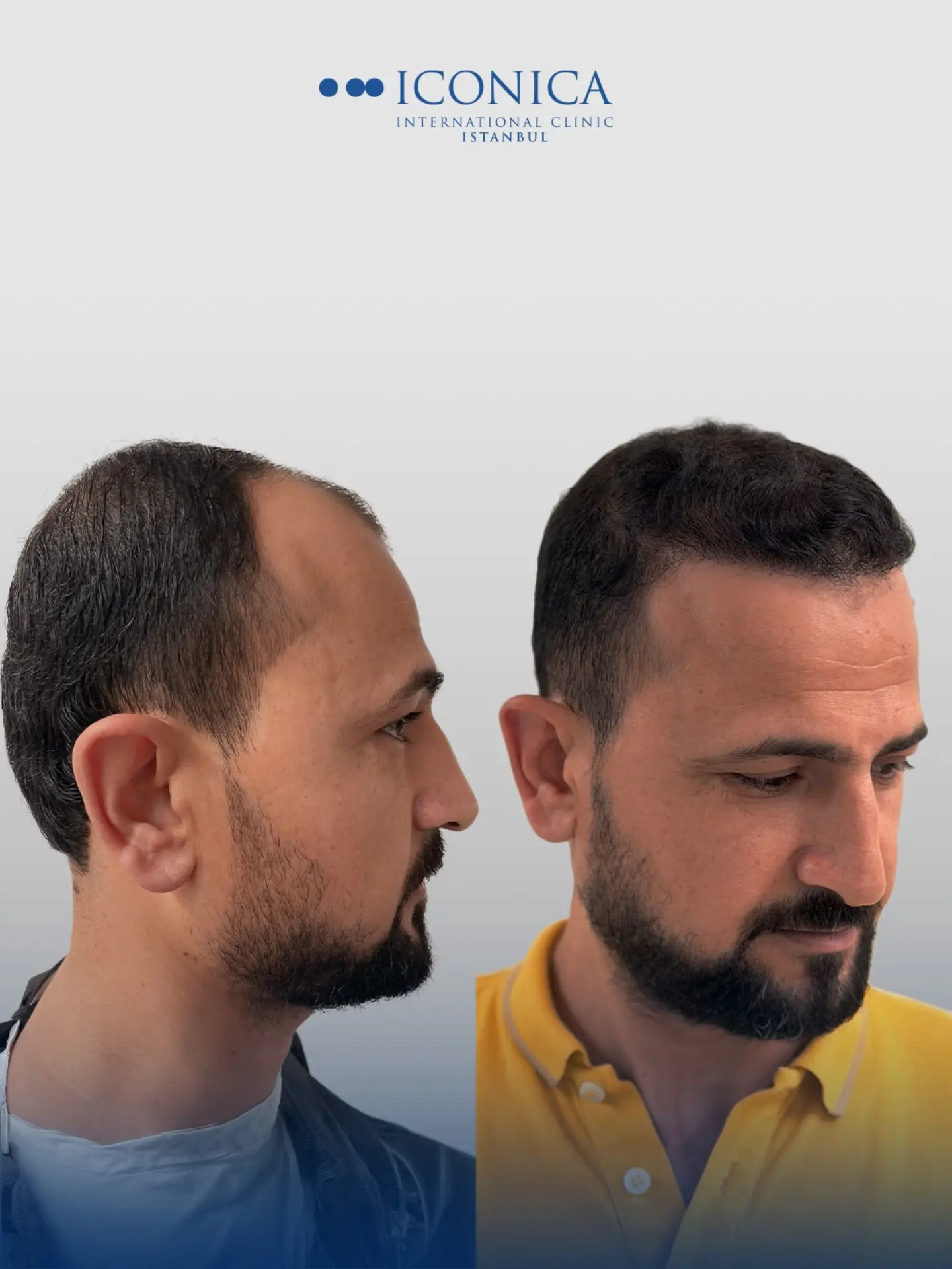 Before and After  graft    transplant at 