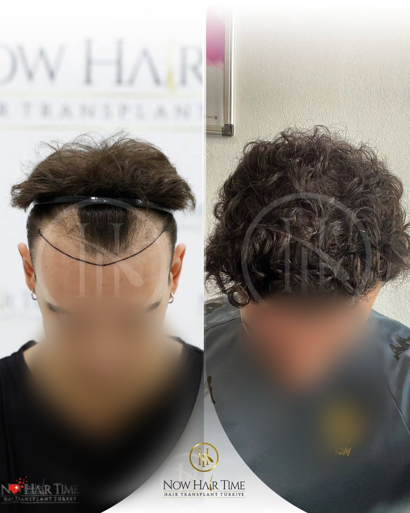 Before and After  graft    transplant at 