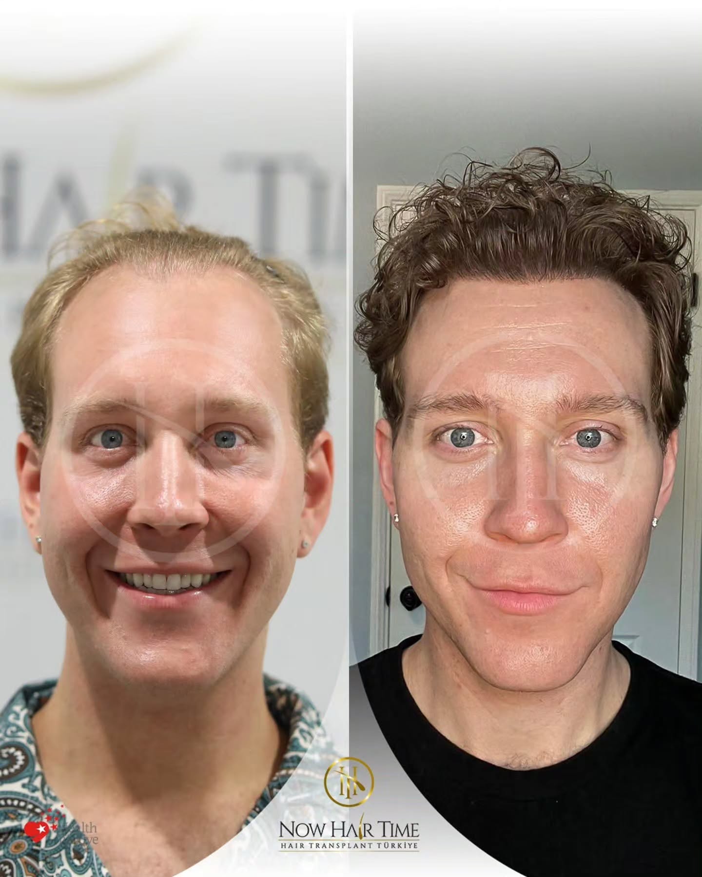 Before and After  graft    transplant at 