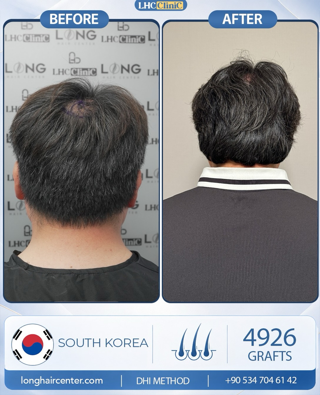 Before and After  graft    transplant at 