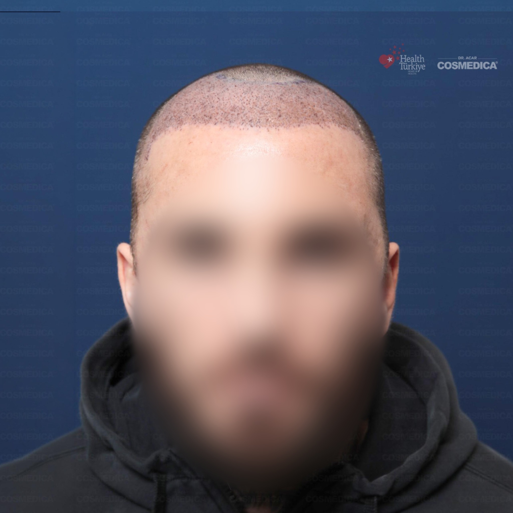 5500 grafts DHI hair transplant result before and after