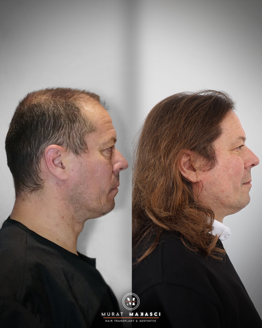 Before and After  graft    transplant at 