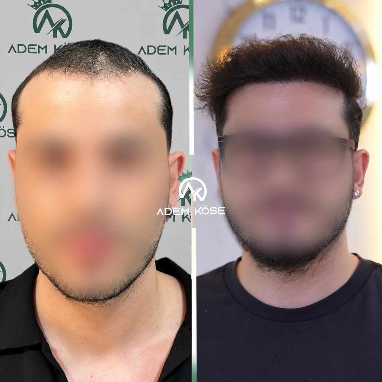 4000 graft FUE hair transplant result before and after