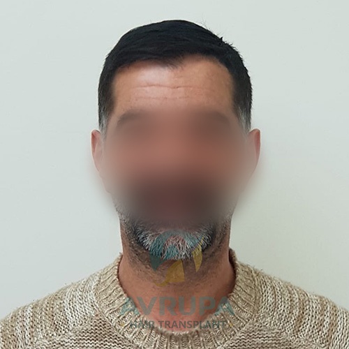 5500 graft FUE hair transplant result before and after