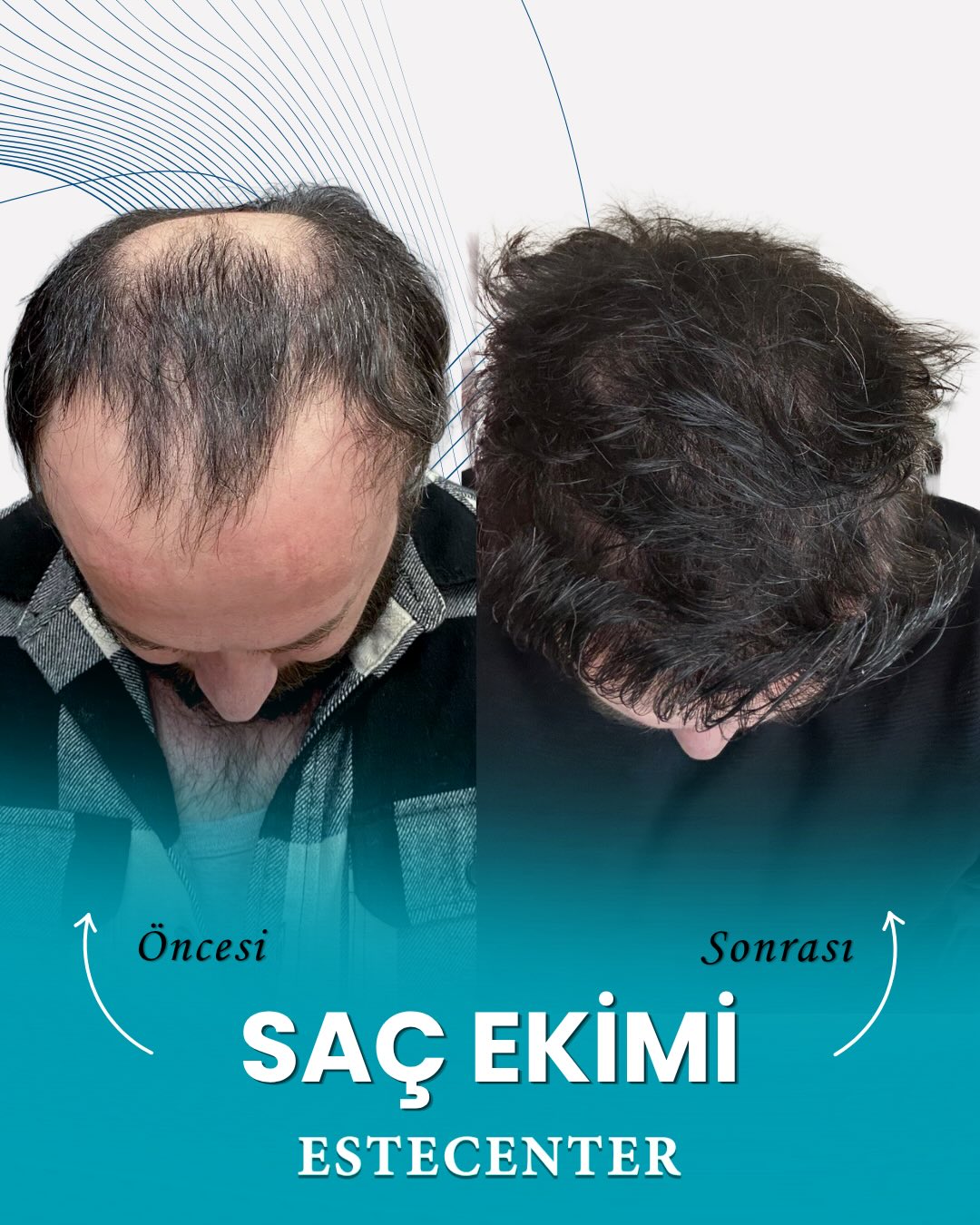 Before and After  graft    transplant at 