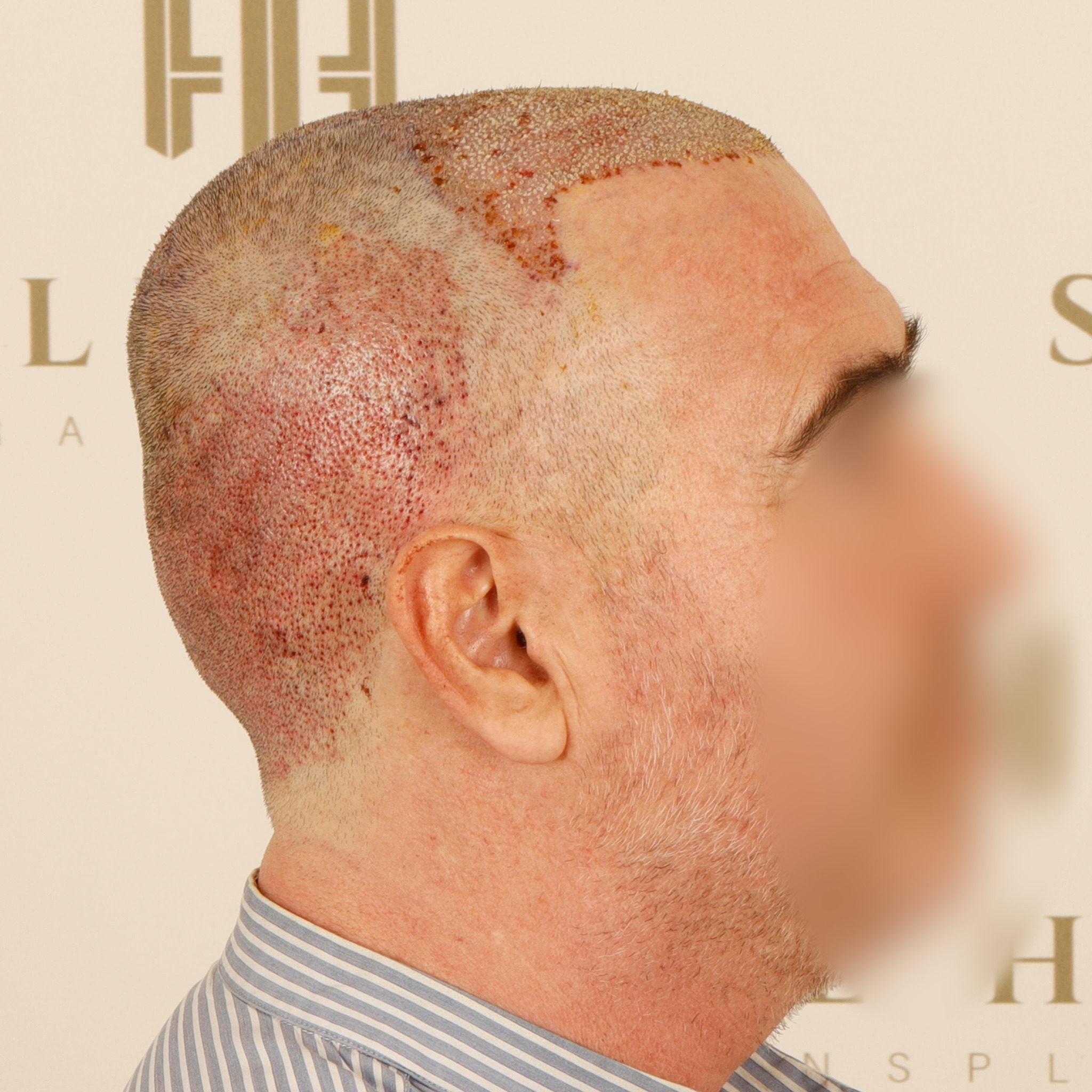 Before and After  graft    transplant at 