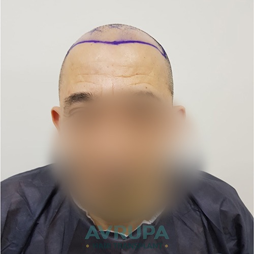 Before and After  graft    transplant at 
