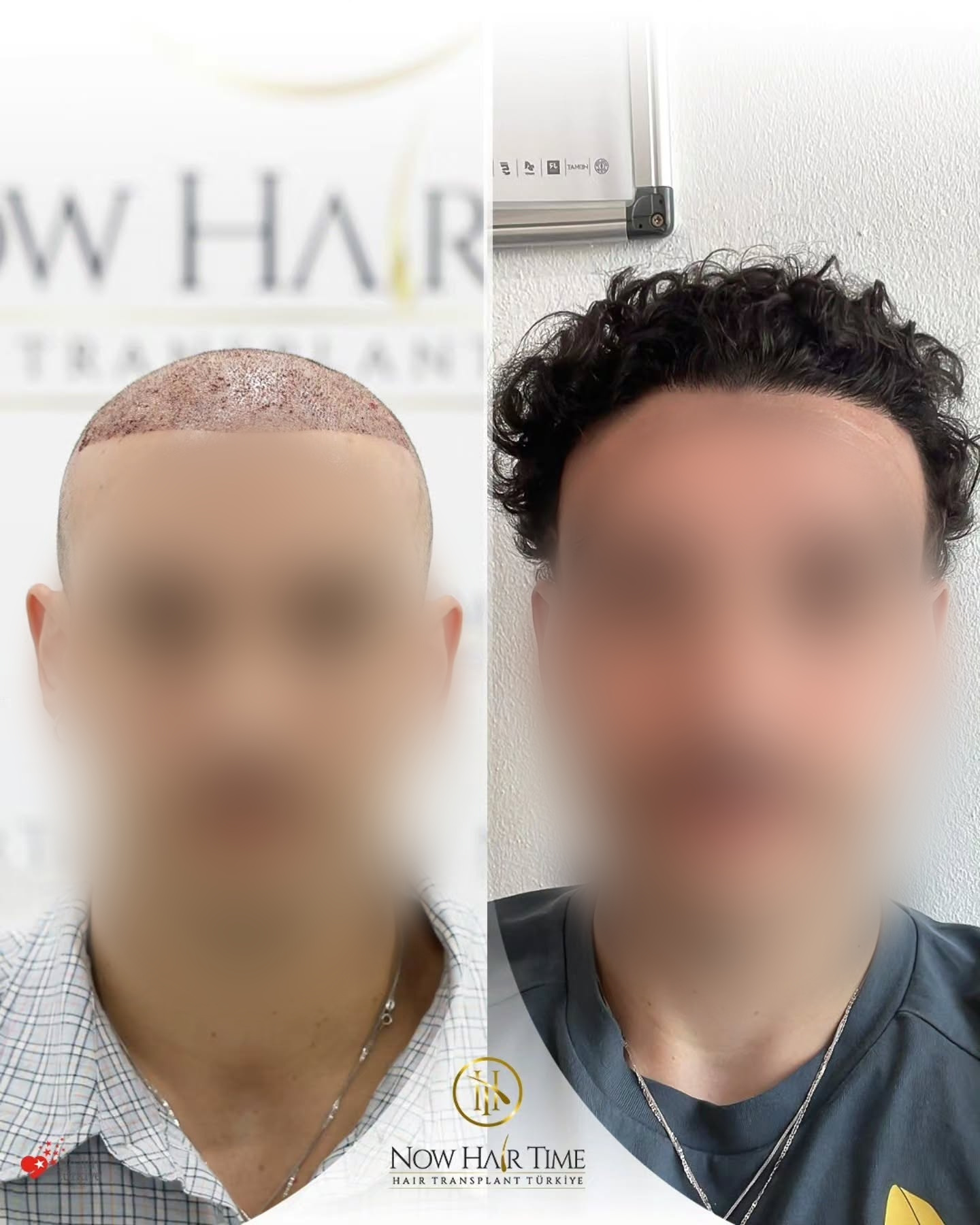 Before and After  graft    transplant at 