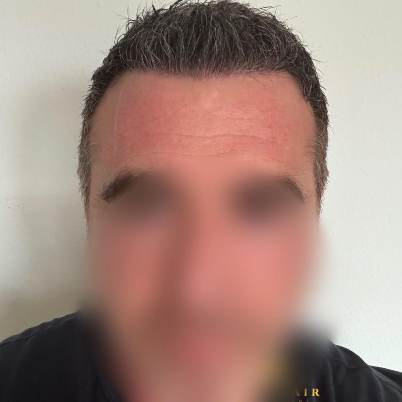 Before and After  graft    transplant at 